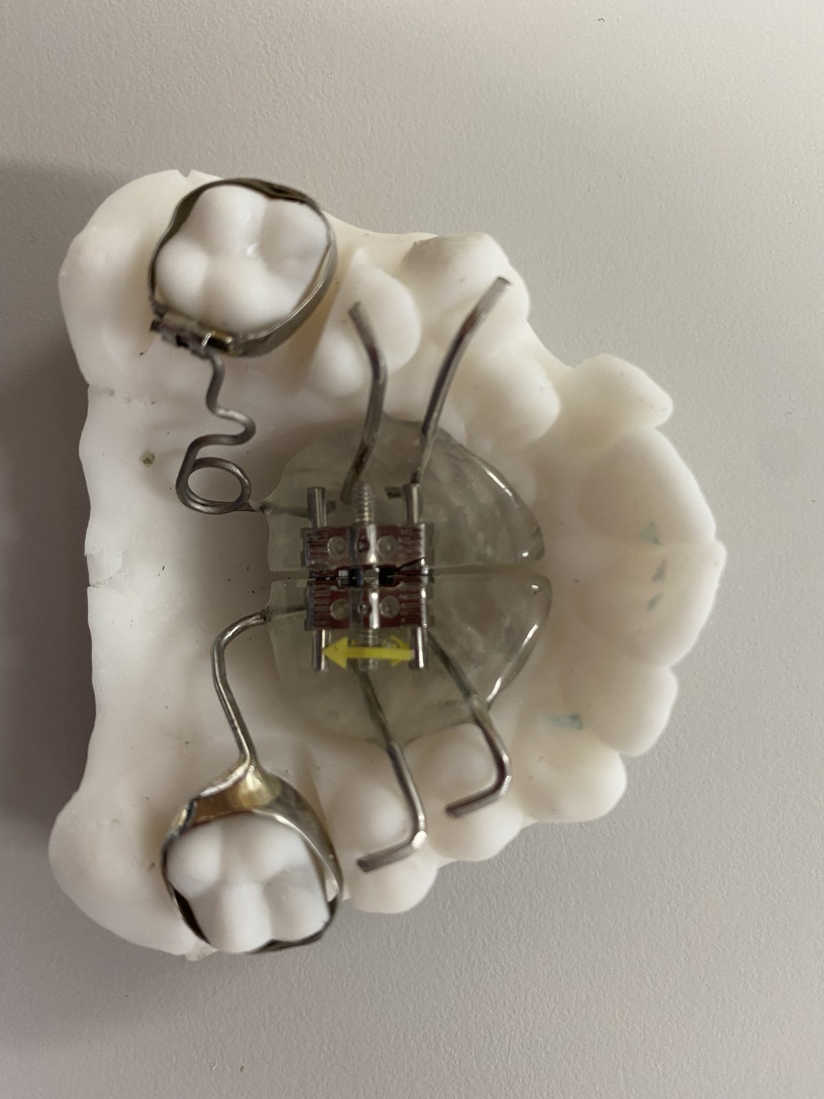 Palatal expander on a dental model, used in early orthodontic intervention at Claremont Orthodontics
